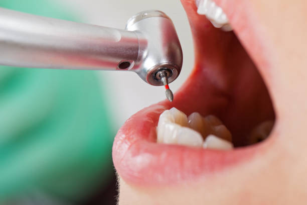 Best Emergency Tooth Extraction in Madison Heights, VA
